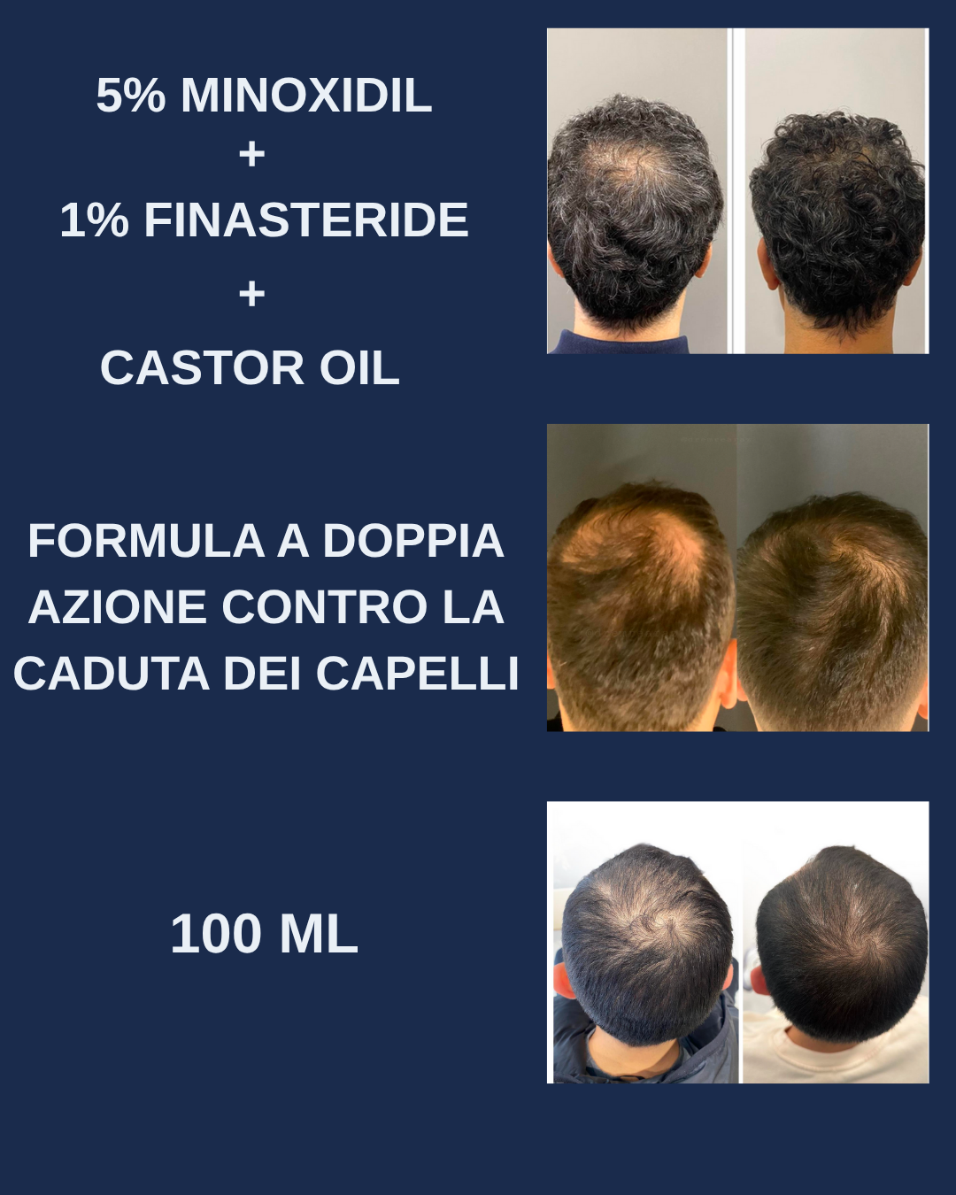Spray Capelli Minoxidil 5% – Trattamento Doppia Azione per un Supporto Mirato del Cuoio Capelluto